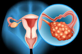 Ovarian Cancer Symptoms Every Women Should Know
